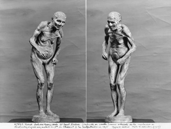 Parkinson's Statuette