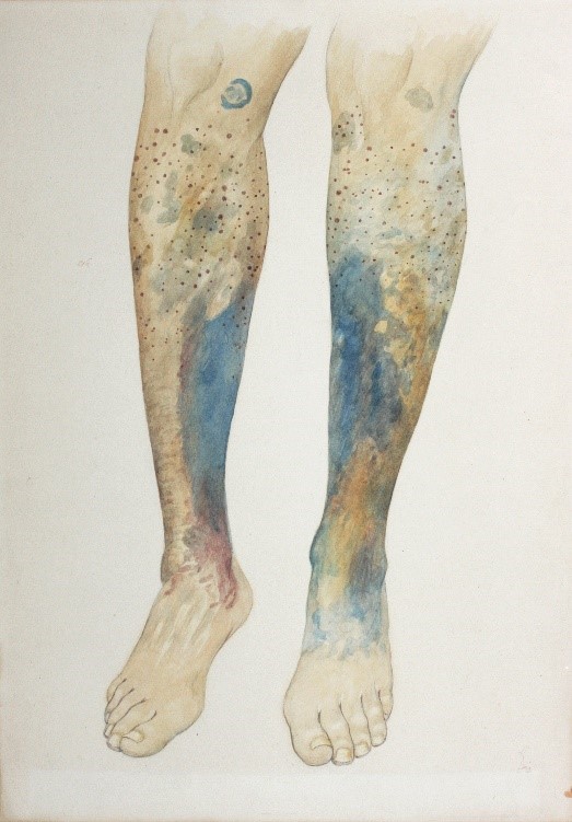 An early painting of bleeding and bruising under the skin of the legs, typically seen in scurvy. Courtesy of the Surgeons’ Hall Museums.