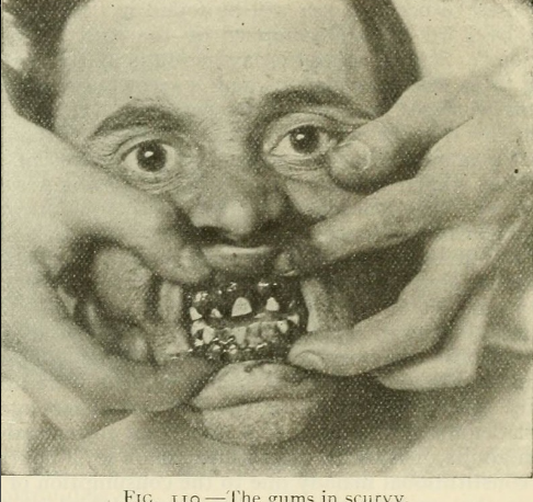 An early illustration (1919) of scurvy mouth with bleeding, tooth loss and overgrowth of the gums over the teeth. (Courtesy Open Knowledge Commons)
