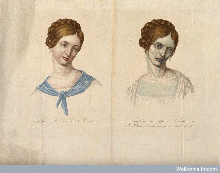 A young woman, aged 23, depicted before and after contracting cholera, Coloured stipple engravin