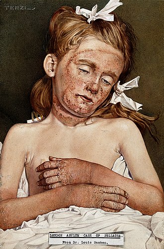 A Girl in the London Asylum Suffering From Pellagra - Engel Terzi
